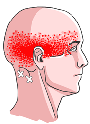 cervicogene hoofdpijn